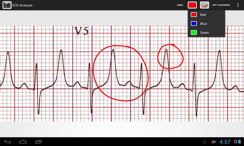 ECG Analyzer