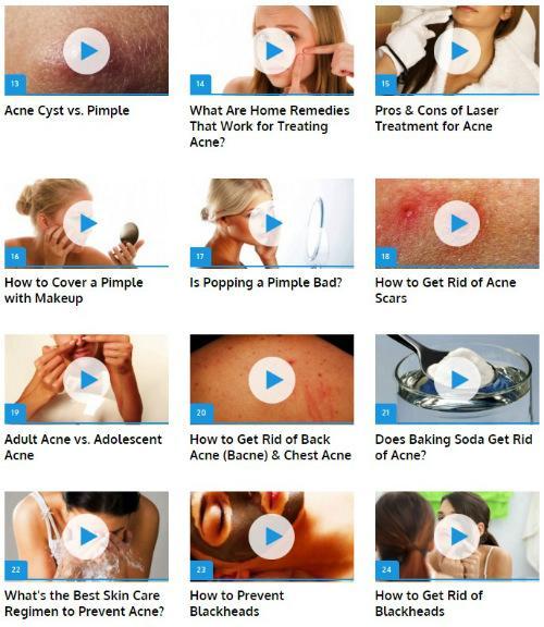 Get Rid of Acne Guide