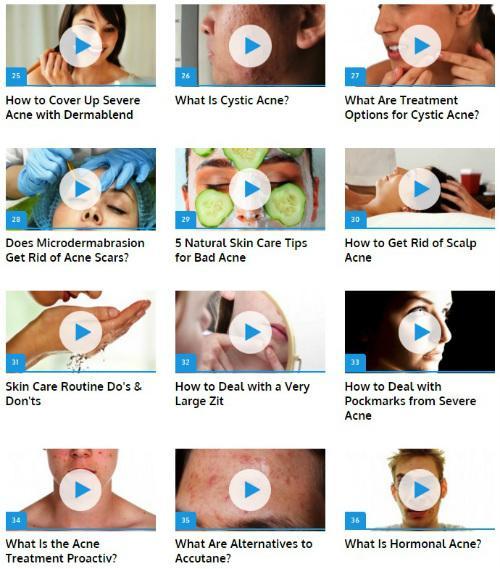 Get Rid of Acne Guide